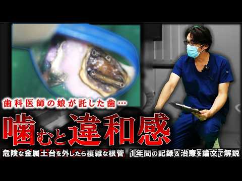 【歯科医師の娘が託した歯】噛むと重い違和感…危険な金属土台を外し複雑な根管（イスムス）を治す再根管治療。１年後の治癒記録