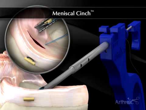 Fazendo uma Cirurgia de Joelho em Realidade Virtual - Wraith VR