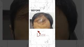 Forehead Hair Transplant Before After