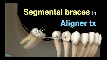 Using segmental braces to close large spaces in aligner treatment｜【Chris Chang Ortho】CC720