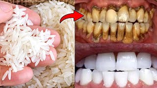 Teeth Whitening and Scaling at Home in 1 Minute | Tartar and Plaque Removal at Home