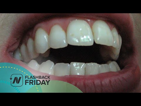 Видео: Какво изплакване на устата с хлорхексидин глюконат?