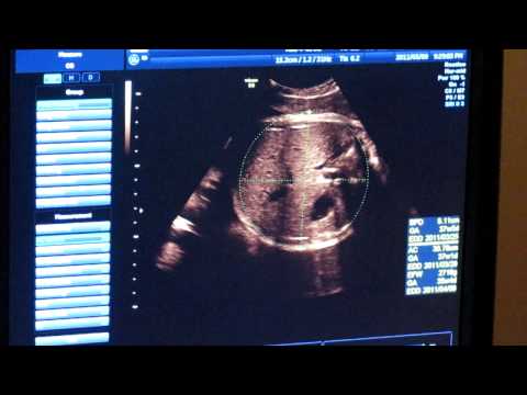 20110309-第14次產檢(柏仁)02 38周又2天, 2980克.MOV