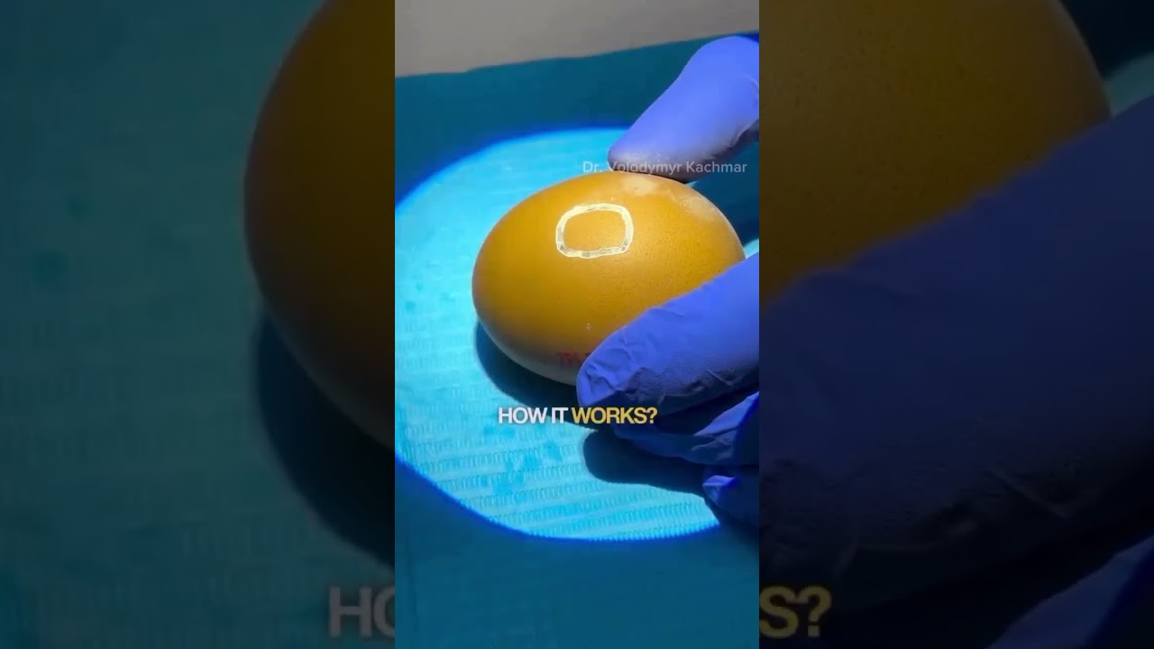 Sinus Lifting Procedure For Implant Placement is one of the most difficult dental procedures.