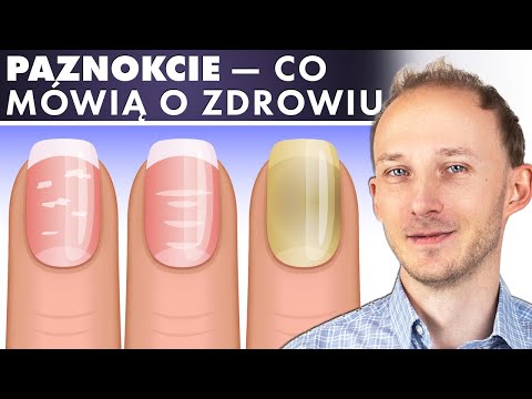 Wideo: Dlaczego paznokcie stają się żółte
