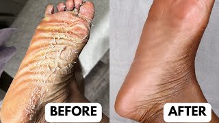I BOUGHT THE CHEAPEST FOOT PEEL MASK ON AMAZON | WAS IT WORTH IT?!