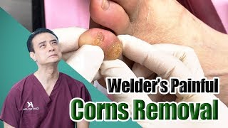 Welder’s Painful Corns & Calluses Removal