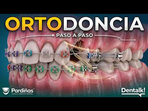 Esto Es Lo Que Sucede En Tu Boca Con Ortodoncia | Transformación Paso A Paso