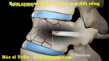 Bơm cement điều trị lún xẹp đốt sống do loãng xương