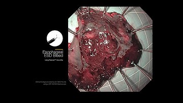 Esophageal ESD Bleed using Retentia™ HemoClip with Dr. Nikhil Kumta