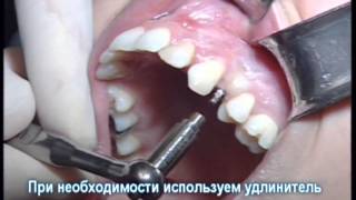одиночная коронка на MDI видео Если выпал зуб!