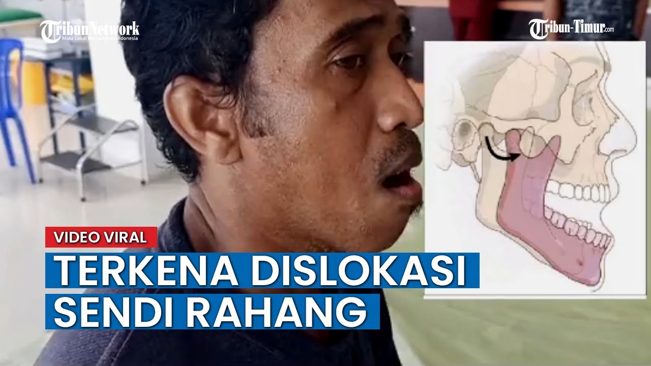 VIRAL Akibat Menguap Terlalu Lebar, Seorang Pria Terkena Dislokasi