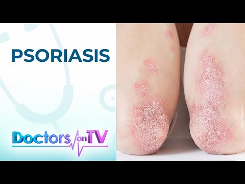 Video: 3 Mga paraan upang gamutin ang Erythrodermic Psoriasis