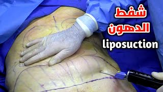 شاهد عملية شفط الدهون_vaser liposuction