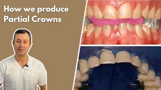 Famous Partial Crowns Explained Net Worth