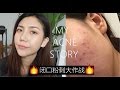 三个月打败！闭口粉刺！my acne story｜ANNBITION