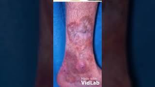 #PAN #Poly artritis #nodosa  Approach to palpable #purpura ( #vasculitis investigation)