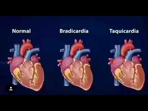 Video: It G'ayritabiiy Yurak Ritmi - G'ayritabiiy Yurak Ritmi Iti