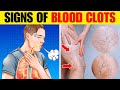 TOP 11 Warning SIGNS of BLOOD CLOTS That Should NEVER Be Ignored