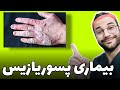 بیماری پسوریازیس یا صدفک Psoriasis 