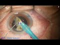 Managing an intumescent cataract with hard nucleus  pradip mohanta 2nd feb 2024