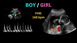Heartbeat Ultrasound | Boy or Girl Gender Prediction | Fetal Heartbeat Sound