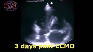 Cardiac recovery with ECMO support in a case of CO poisoning induced cardiomyopathy