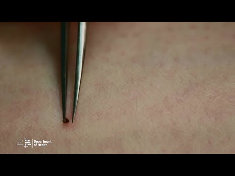 Video: Tick bites: Symptomer, Behandlinger, Billeder Og Forebyggelse