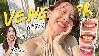 แค่ทำวีเนียร์หน้าก็เปลี่ยน!! 🦷เหลาฟันเยอะมั้ย?! รีวิวแบบละเอียดทุกขั้นตอน✨| Ning Arisa