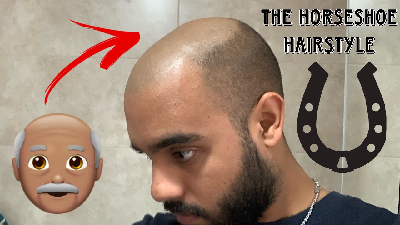 5 Effective Steps To Battle Male Pattern Baldness