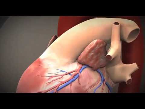 UCLA TAVR - Transcatheter Aortic Valve Replacement