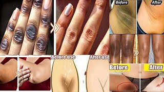 HOW TO GET RID OF DARK UNDERARMS DARK KNUCKLES, ELBOWS AND KNEES FAST (LIGHTEN YOUR HANDS INSTANTLY)