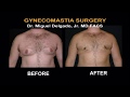 Gynecomastia surgery  before and after photos by miguel delgado md