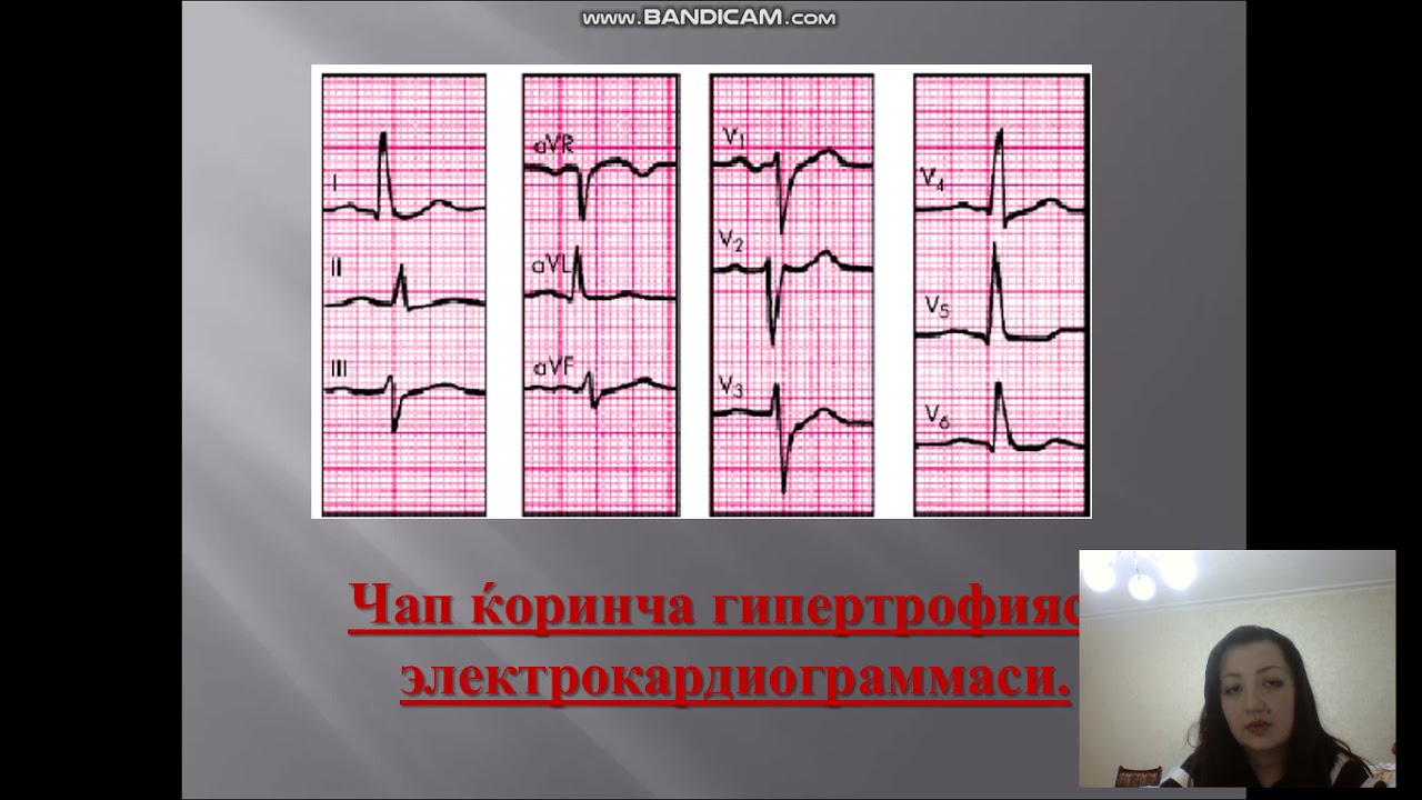 Arterial gipertoniya