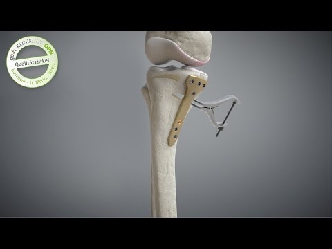 Video: Was bedeutet Osteometrie medizinisch?