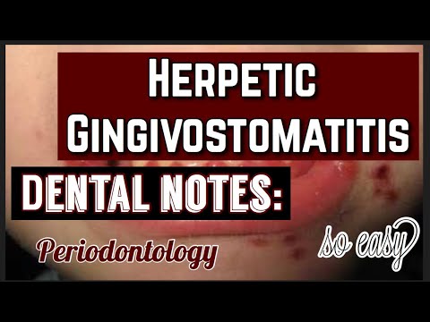 HERPETIC GINGIVOSTOMATITIS II PERIODONTOLOGY II ORAL PATHOLOGY II DENTAL NOTES II MADE EASY