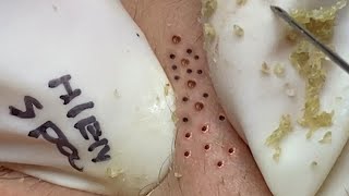 Satisfying video with Hien Nguyen Spa Beauty #013