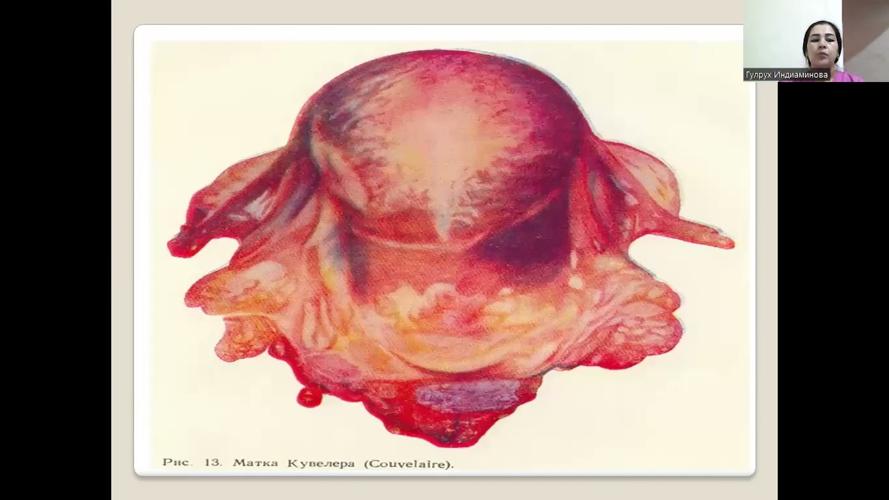 Homiladorlik, tug'ruq va tug'ruqdan keyingi davrda qon ketishi