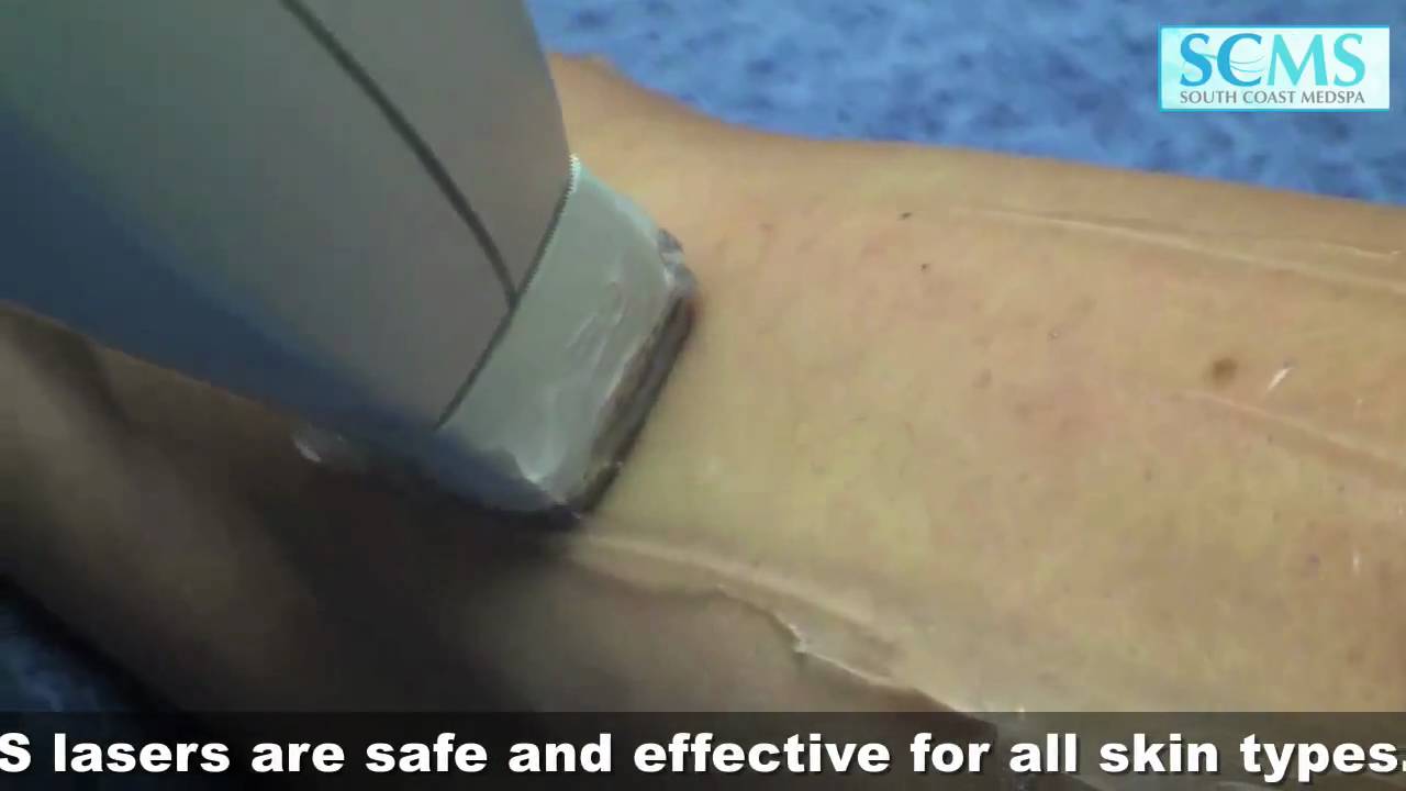 Laser Hair Removal Side Effects - YouTube