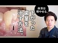 札幌市の「ユアーズデンタル クリニック」歯肉退縮の治療法について説明