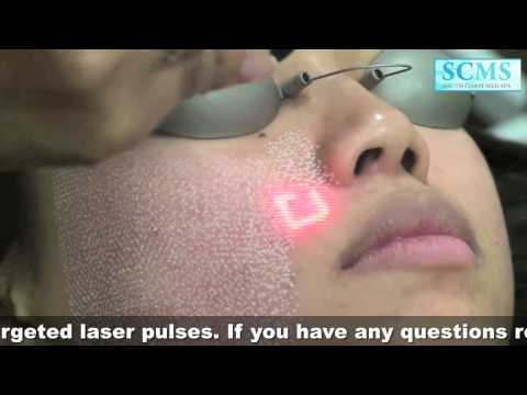 Laser Acne Scars