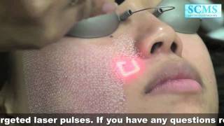 Penang laser acne tratamento para a