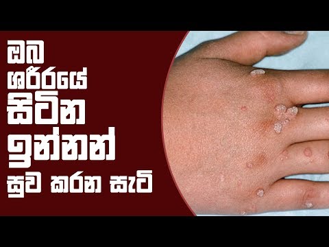 ඔබ ශරීරයේ සිටින ඉන්නන් සුව කරන සැටි