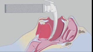 HEINE FlexTip  Fiber Optic Laryngoscope Blades / RichardsMedical.com