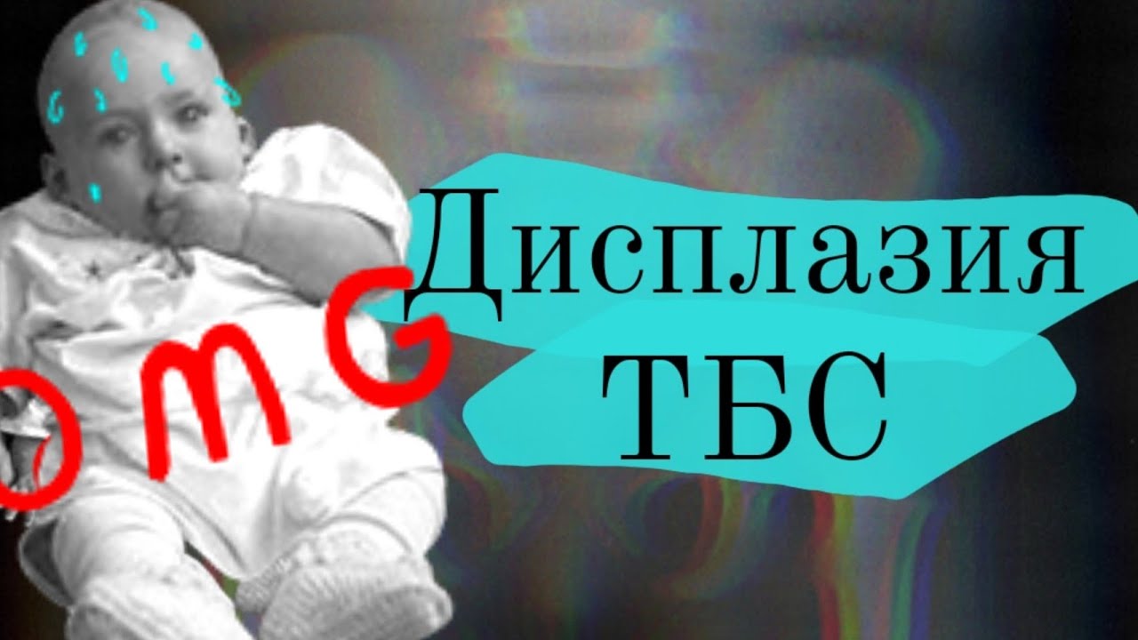 Дисплазия тазобедренного сустава: рентген👶
