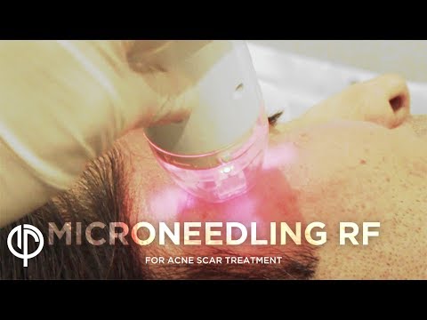 Acne Scar Treatment | Microneedling RF | Acne Scar Treatment Dermatologist | Dr. Jason Emer