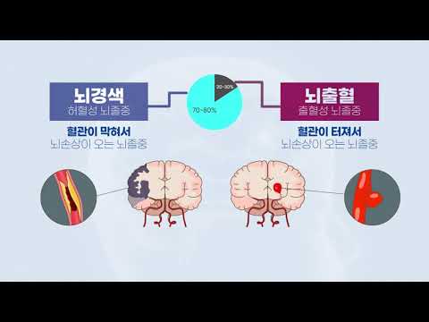 [뇌혈관을 부탁해] 허혈성 뇌졸중(뇌경색)이란 - 뇌경색 바로 알기