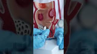 How To Insert Suppositories