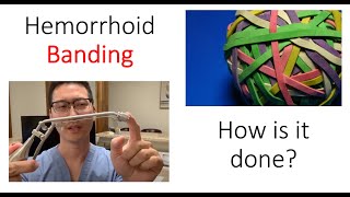 What is a hemorrhoid banding? I show you how it
