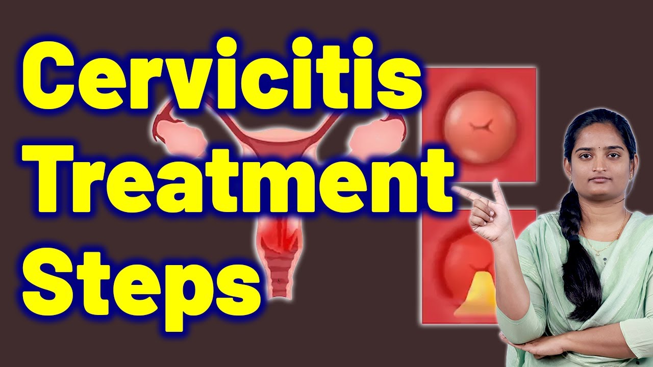 Cervicitis Treatment Steps | Cervical Mucositis, Endocervicitis ...